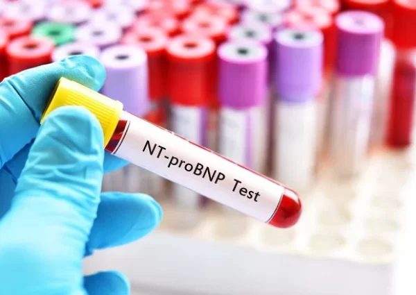nt probnp test
